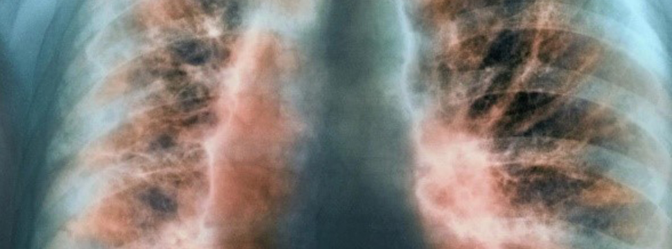 Нерандомиласт от Boehringer Ingelheim показал эффективность при ИЛФ и ПЛФ в исследованиях III фазы