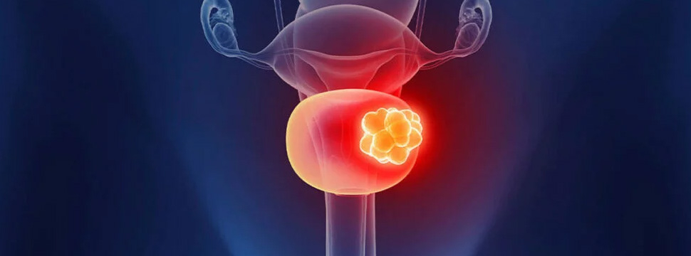 FDA впервые одобрило препарат UroGen для лечения рака мочевого пузыря