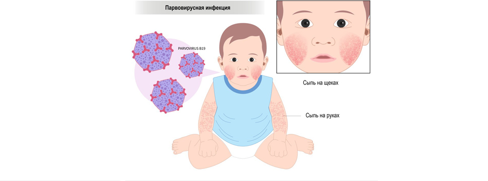 Вместо кори новый вирус? Родители в Астане жалуются на необычные симптомы у детей
