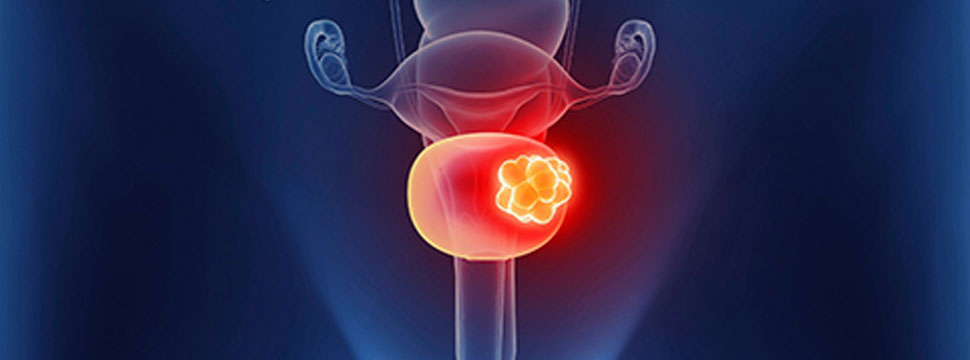 FDA одобрило препарат ImmunityBio для лечения рака мочевого пузыря