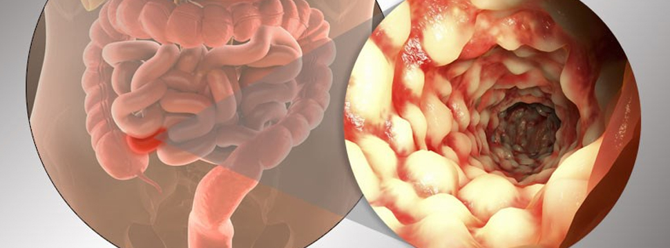 Acta Biomaterialia: учёные создали клейкий гель для эффективного лечения кишечных свищей