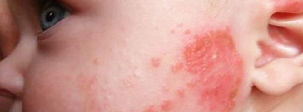 FDA одобрило нестероидную альтернативу при атопическом дерматите у детей 2–5 лет