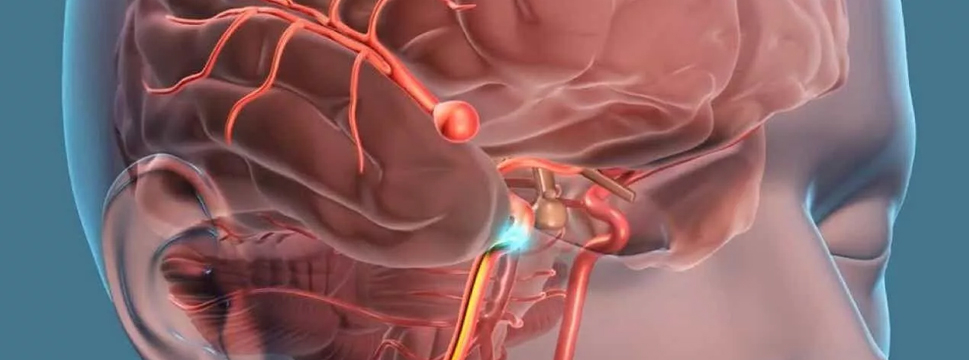 Neurology: препарат снижает риск инсульта и разрыва аневризмов мозга